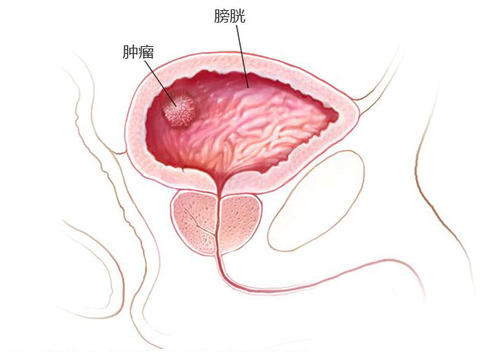 膀胱腫瘤最新治療方法,膀胱腫瘤最新治療方法，小巷深處的醫(yī)學(xué)奧秘