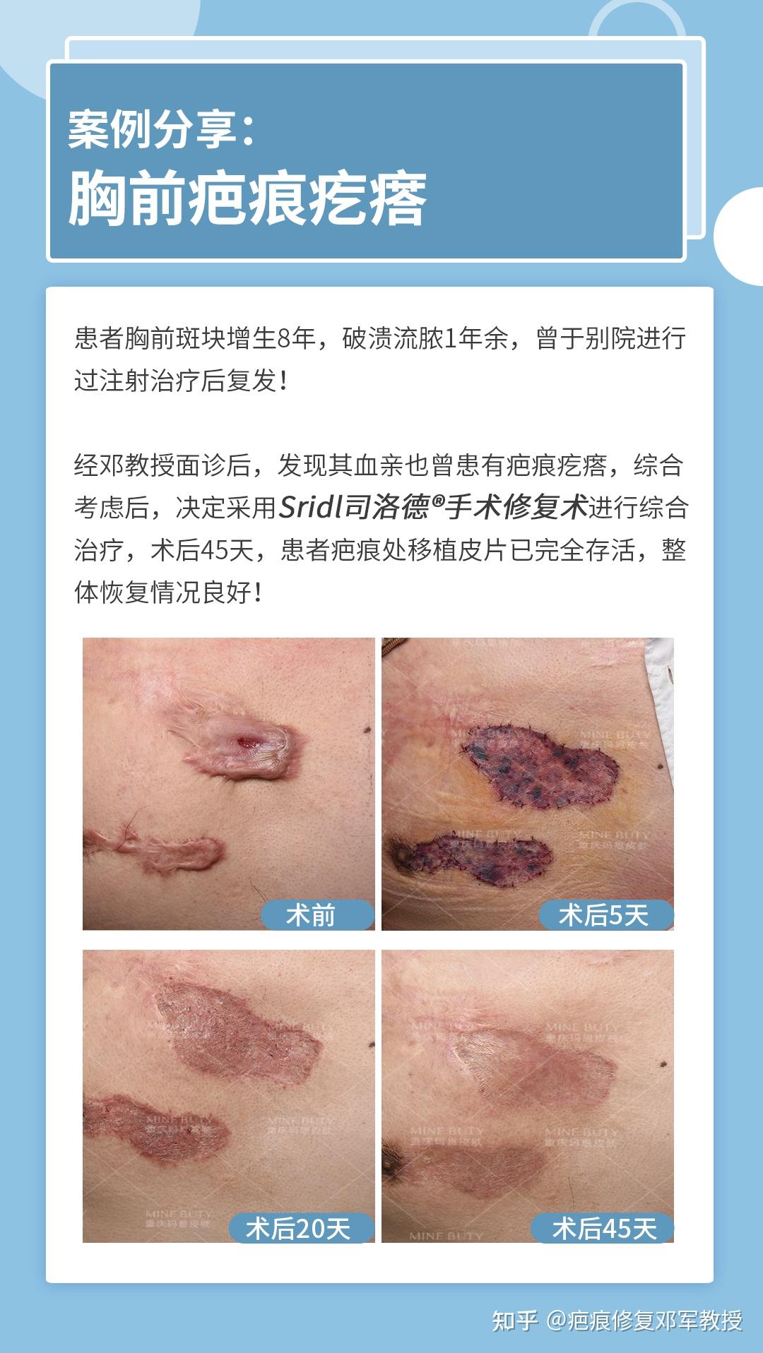 疤痕最新研究進(jìn)展與治療進(jìn)展，探索最新治療方法和策略